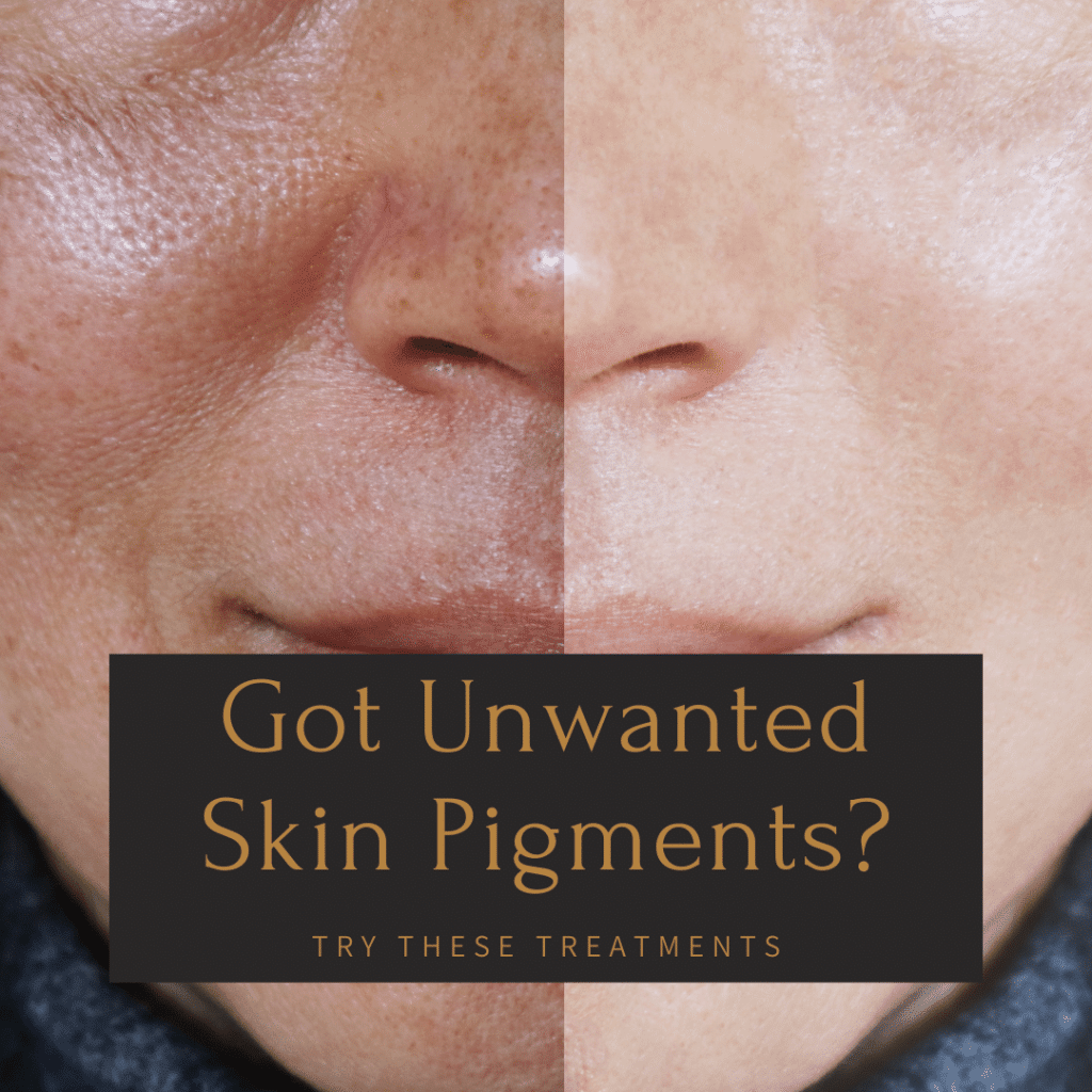 Are you one of the many people who knows just how frustrating unwanted skin pigments are? You work hard to maintain a healthy lifestyle and skin care routine, only for your face to betray you with dark spots and discoloration. The good news is that there are ways to get rid of these unwanted skin pigments. In this blog post, we will discuss different types of skin pigmentations–including hyperpigmentation–and what treatments at Therapeutic Aesthetics in Pickering can help you get rid of them. skin pigmentation TYPES OF SKIN PIGMENTATIONS All skin contains colored pigments known as melanin. Lighter skin contains lower amounts of melanin, while darker skin contains higher amounts. Uneven skin tone occurs when there are areas of lighter or darker pigmentation that does not match the rest of the skin. While many types of skin pigmentations are harmless, many people seek treatment as a way to decrease their appearance. Before you start treating skin pigmentations, however, it is important to first identify the type of skin pigmentation you are dealing with. There are different types of skin pigmentations including: Melasma: This is the most common type of skin hyperpigmentation. It typically appears as brown patches on the face, and is often triggered by sun exposure or hormonal changes. Post-inflammatory hyperpigmentation (PIH): PIH can be caused by a number of things, including acne, eczema, psoriasis, rashes, or even injuries to the skin. This type of skin pigmentation can appear as darker or lighter spots on the skin and may not fade until several months after the initial injury occurred. Some examples can include burns, blisters, or acne scars. Sun Damage: Sun damage can cause your skin to become darker over time. The good news is that it usually fades when you stop exposing yourself to harmful UV rays. Liver spots/Sun Spots: Liver spots, also known as sunspots or solar lentigines, are the result of years of skin damage induced by sun exposure. These “spots” typically appear on your hands, face, or anywhere that is frequently exposed to the sun. People with fair complexions tend to experience liver spots more often than darker toned people. Birthmarks: like their name suggests, birthmarks are skin discolorations that are present at birth. Vascular birthmarks are due to abnormal blood vessels in the skin and pigmented birthmarks are due to problems with melanin in the skin. There are different types of birthmarks such as: strawberry nevus, port wine stain, salmon path, Mongolian blue spots, moles, and cafe-au-lait spots, to name a few. skin pigmentation WHAT YOU CAN DO TO GET RID OF UNWANTED SKIN PIGMENTATION When it comes to getting rid of unwanted skin pigments, skin resurfacing treatments are highly effective. There are different types of skin resurfacing treatments, including: Chemical Peels A chemical peel is a way to treat facial wrinkles, acne scars, hyperpigmentation spots, sun damage, age spots (liver & sunspots), and other blemishes on your face without having to undergo surgery or downtime. To perform a chemical peel, a chemical solution is applied to the skin which causes the top layer of skin cells to peel away. This reveals the fresh, new skin below. Laser Resurfacing Laser resurfacing is a treatment that uses laser energy to remove unwanted skin pigments and improve the appearance of your skin. The laser beam targets the dark spots and damages them. This causes the body to produce new skin cells that are more even in color than they were before treatment. Radio Frequency Skin Resurfacing Both radio frequency skin resurfacing and laser resurfacing are used to treat facial wrinkles, acne scars, hyperpigmentation spots (melasma & post-inflammatory pigmentation), sun damage, age spots (liver & sunspots), or other blemishes on the face. The difference between these two treatments is that with radio frequency treatment, the heat from radio frequency energy is delivered through a hand piece to create tiny dermal wounds that stimulate the production of collagen. The Venus Versa Skin Resurfacing System can treat all types of unwanted skin pigmentation without causing post-inflammatory hyperpigmentation, even in people with darker skin tones. Microneedling Microneedling is a minimally invasive treatment that uses tiny needles to create controlled micro-injuries in the skin. This causes the body to produce new collagen and elastin, which helps improve the appearance of wrinkles, scars, and hyperpigmentation. IPL Photorejuvenation IPL, or Intense Pulsed Light therapy, is a type of laser treatment that is used to improve the appearance of skin. It works by targeting red and brown pigments in the skin and breaking them down. This helps reduce the appearance of sun damage, age spots, and other blemishes on the skin. skin pigmentation IN CONCLUSION Unwanted skin pigments can be frustrating, but luckily there are ways to improve the appearance of your skin. If you have unwanted skin pigments, there are a variety of different treatments available for your needs including chemical peels, laser resurfacing, radio frequency skin resurfacing, and IPL photorejuvenation. Furthermore, the Venus Versa Skin Resurfacing System is the only skin resurfacing treatment that can safely treat all types of unwanted skin pigmentation without causing post-inflammatory hyperpigmentation in people with darker skin tones. If you need help finding an effective treatment to get rid of your unwanted pigmentations or if you want more information about any of these procedures, please contact us today at Therapeutic Aesthetics in Pickering for a free consultation.