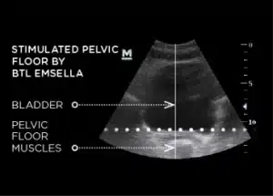 Stimulated Pelvic Floor