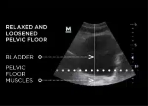 Relaxed and Loosened Pelvic Floor