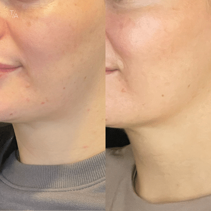 Photofacial Rejuvenation