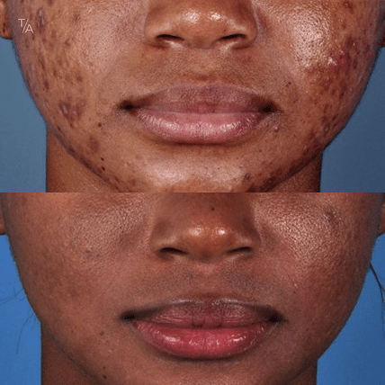 Photofacial Rejuvenation