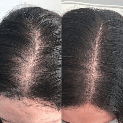 PRP Therapy