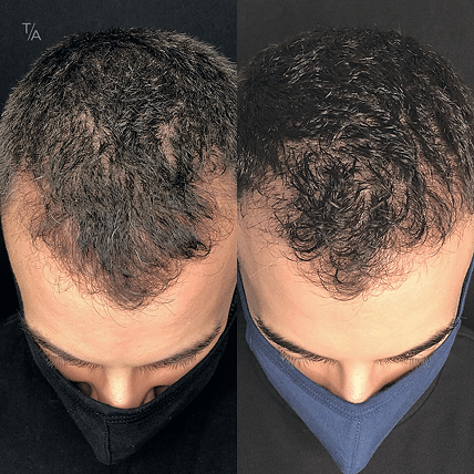 PRP Therapy