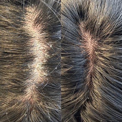 PRP Therapy