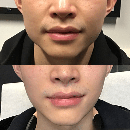 Photofacial Rejuvenation