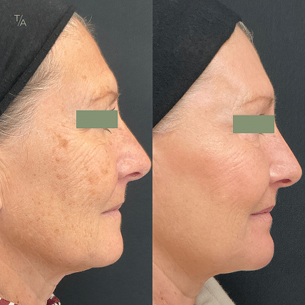 Photofacial Rejuvenation