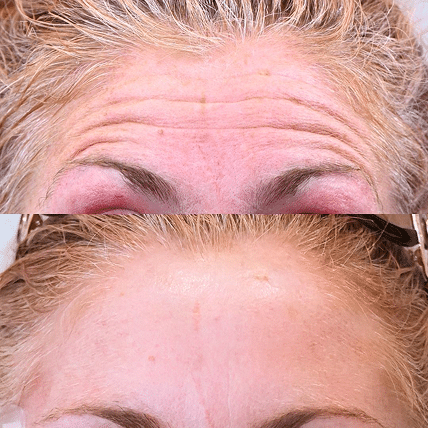 Photofacial Rejuvenation