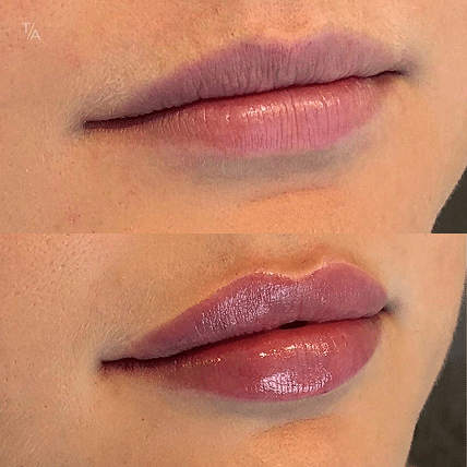 Photofacial Rejuvenation