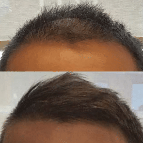 Post-Acne Hyperpigmentation